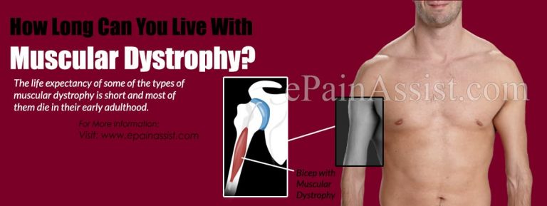 How Long Can You Live With Muscular Dystrophy?