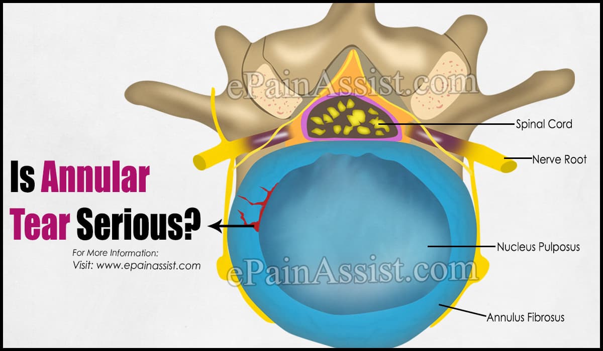 Is Annular Tear Serious?