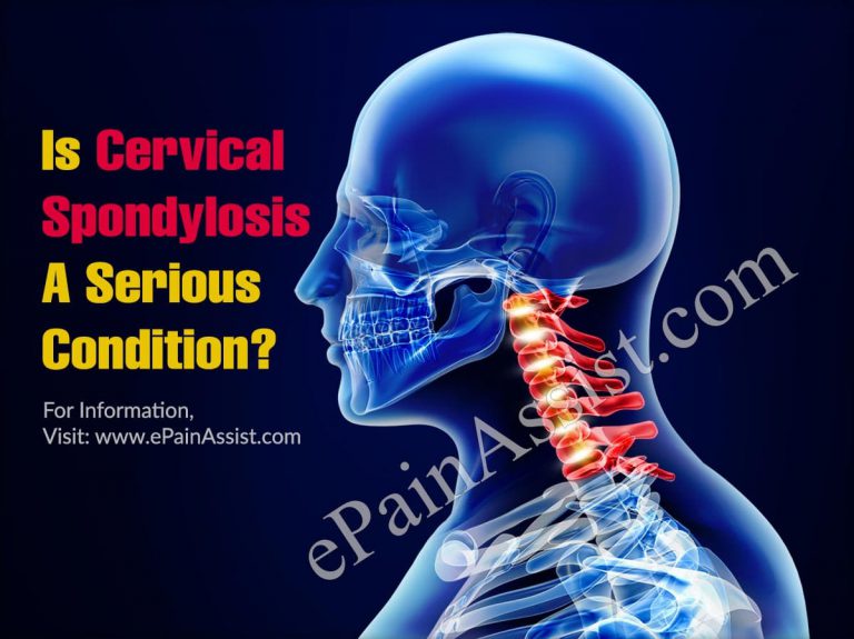 Is Cervical Spondylosis A Serious Condition & How Can It Be Treated?