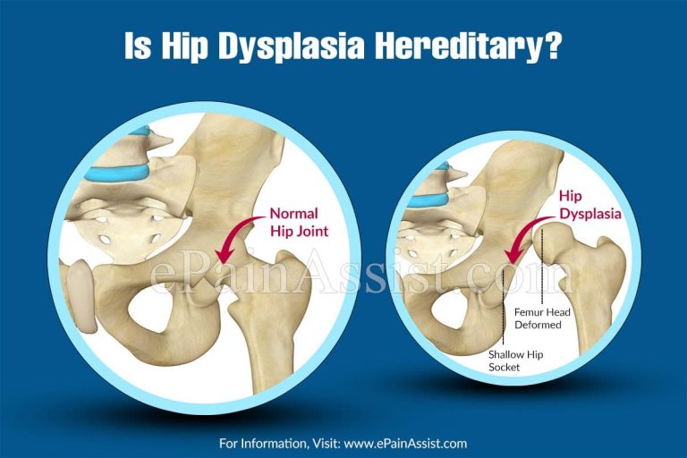 Is Hip Dysplasia Hereditary?