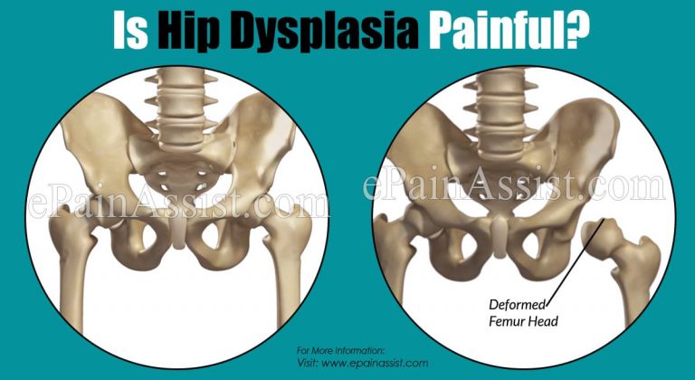 Is Hip Dysplasia Painful?