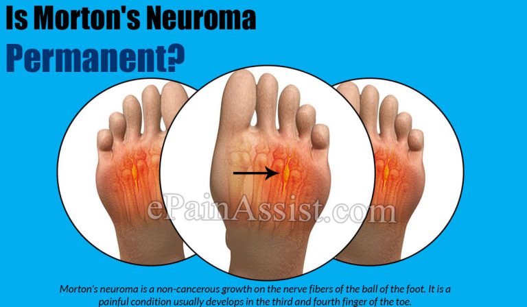 Is Morton’s Neuroma Permanent?