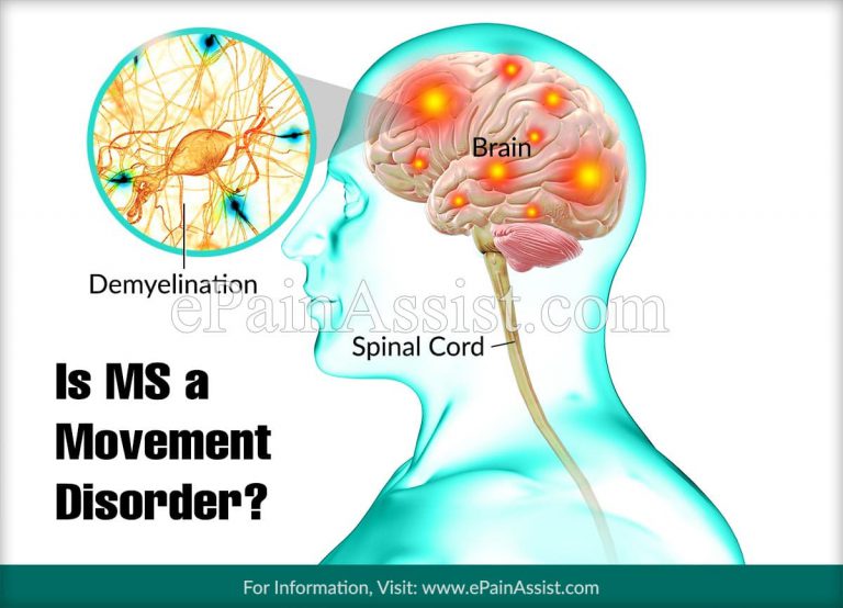 Is MS a Movement Disorder?