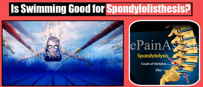 Is Swimming Good for Spondylolisthesis?