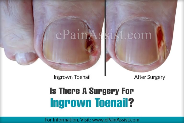Is There A Surgery For Ingrown Toenail?