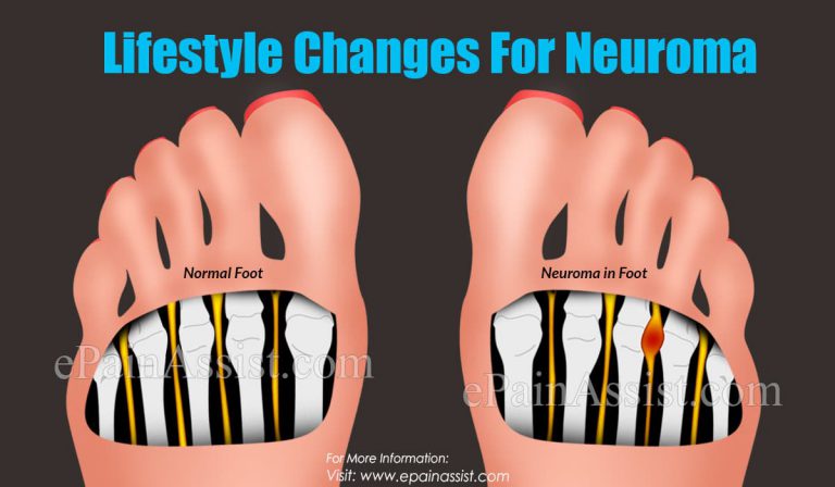 Lifestyle Changes For Neuroma
