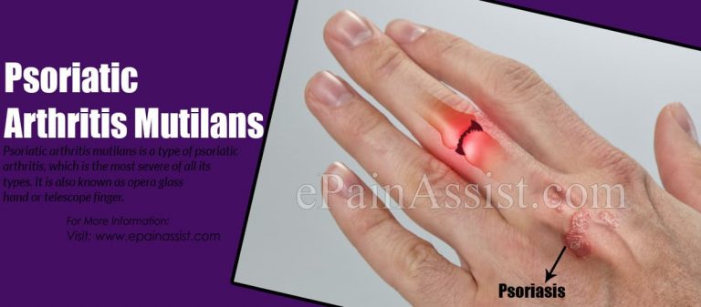 Psoriatic Arthritis Mutilans: Causes, Symptoms, Diagnosis, Risk Factors, Treatment, Prognosis