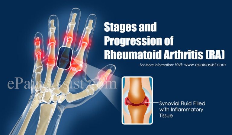 Stages and Progression of Rheumatoid Arthritis (RA)