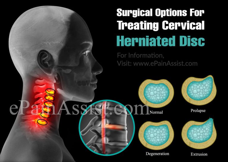 Surgical Options For Treating Cervical Herniated Disc