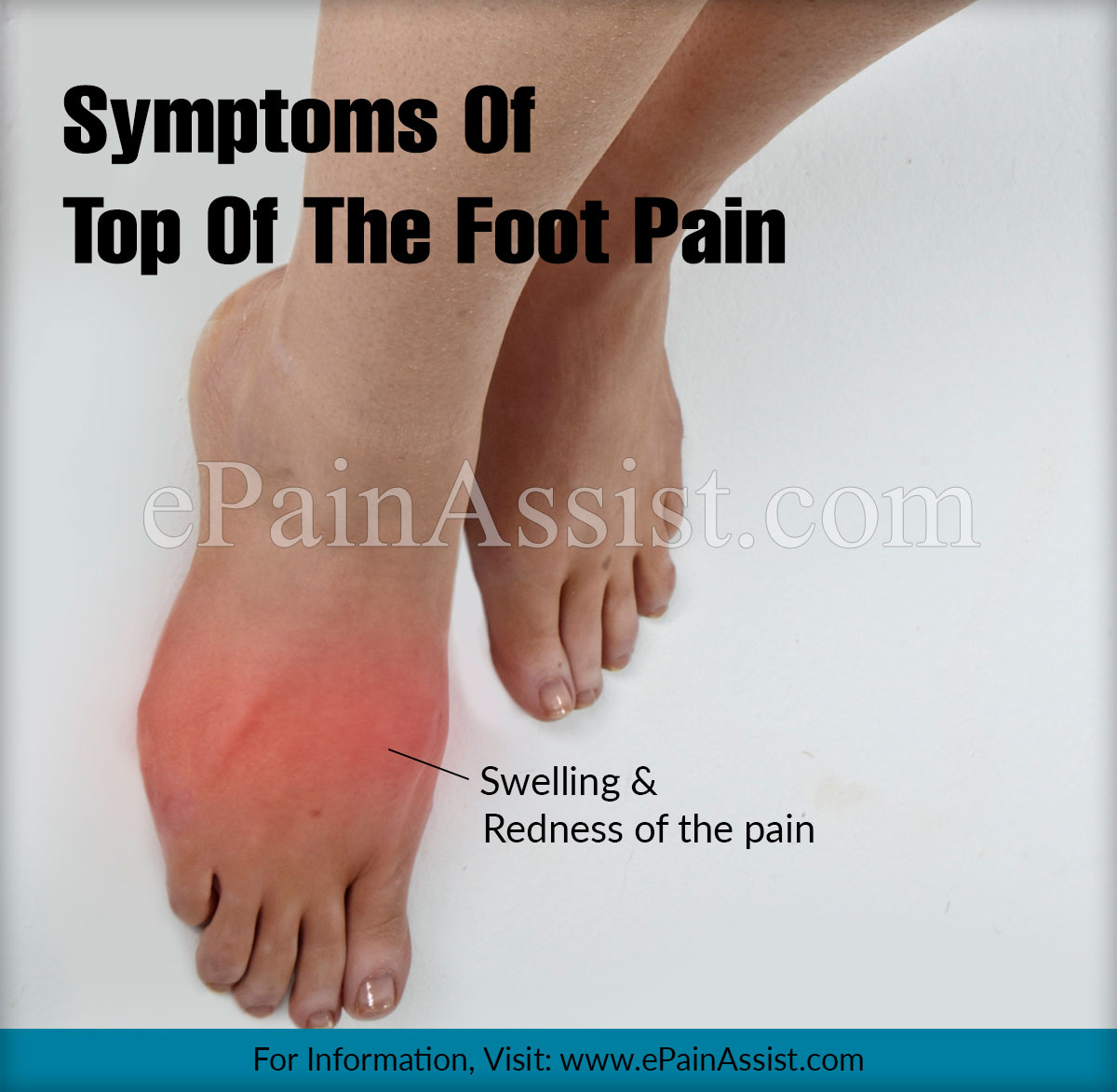 Symptoms Of Top Of The Foot Pain