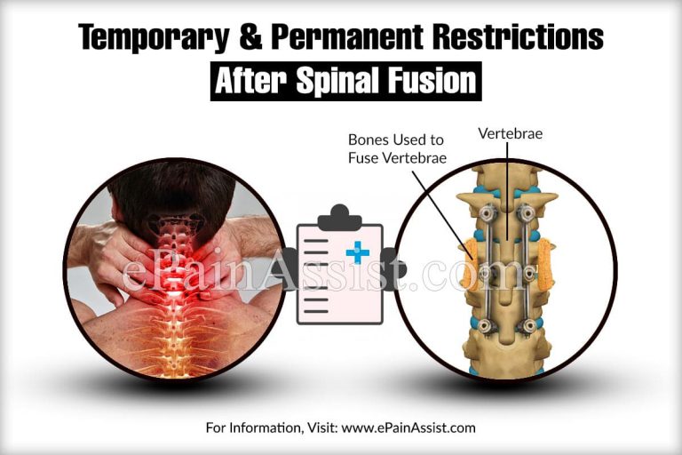 Temporary & Permanent Restrictions After Spinal Fusion