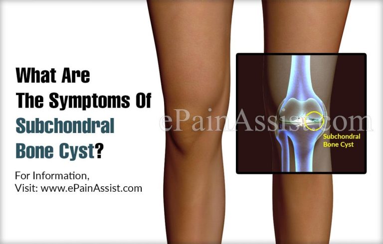 Subchondral Bone Cyst: Causes, Symptoms, Treatment