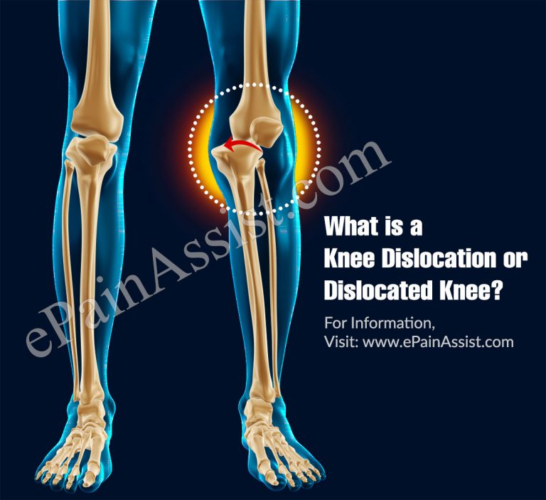 Knee Dislocation or Dislocated Knee: Causes, Classification, Symptoms
