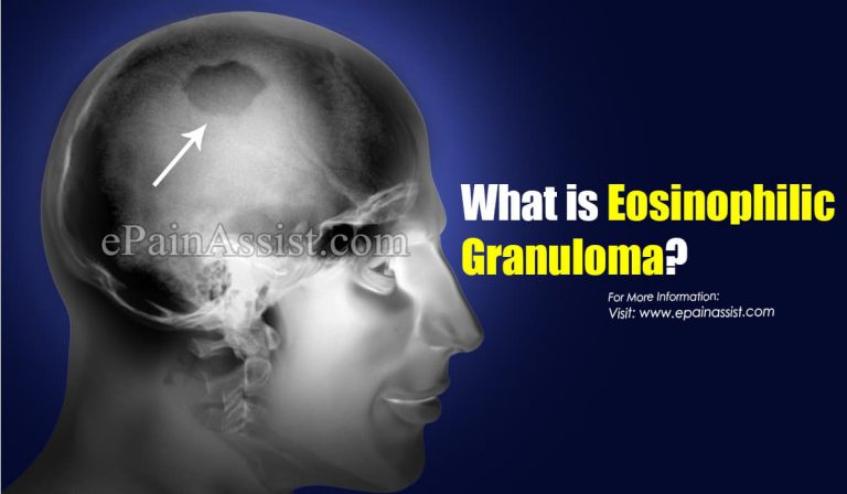 What is Eosinophilic Granuloma & How is it Treated?|Causes, Symptoms, Prognosis of Eosinophilic Granuloma