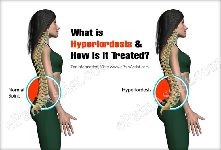 What is Hyperlordosis & How is it Treated? | Causes, Symptoms, Diagnosis of Hyperlordosis