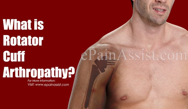 What is Rotator Cuff Arthropathy: Signs, Risk Factors, Treatment, Diagnosis