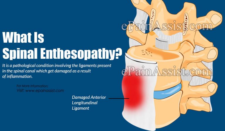 What is Spinal Enthesopathy: Causes, Symptoms, Treatment