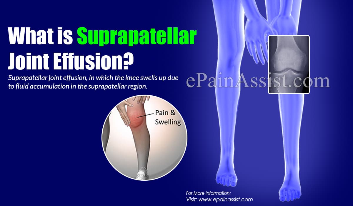 What is Suprapatellar Joint Effusion?