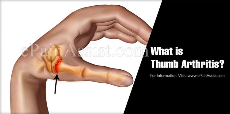 What is Thumb Arthritis & How is it Treated?: Causes, Symptoms, Diagnosis of Thumb Arthritis