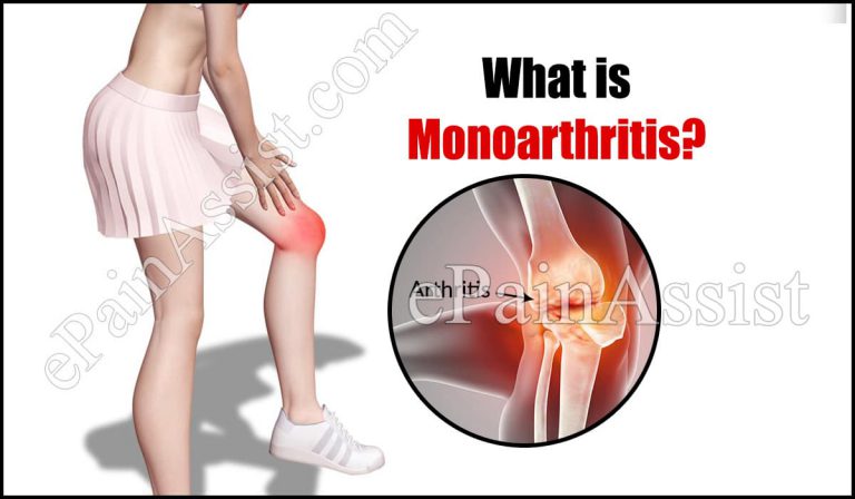 Monoarthritis: Symptoms, Causes, Treatment, Diagnosis