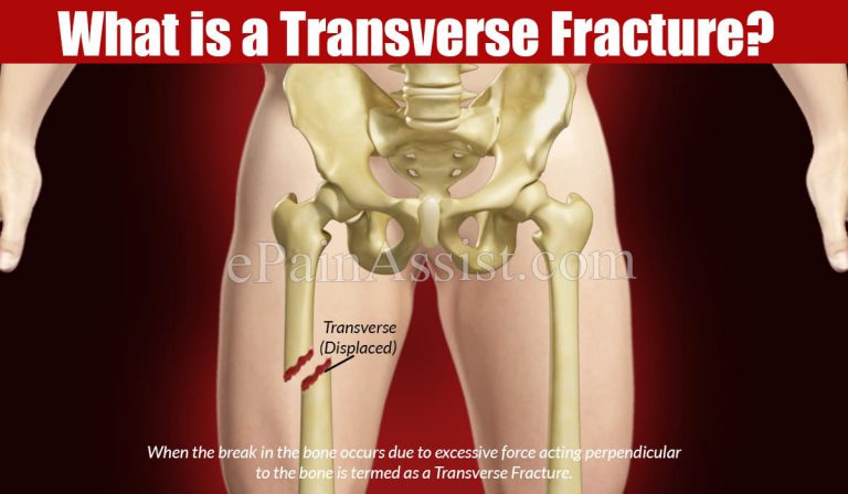 What is Transverse Fracture & How Long Does it Take to Heal?|Causes, Symptoms, Treatment of  Transverse Fracture