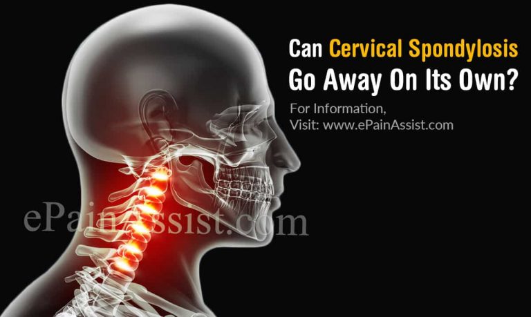 Can Cervical Spondylosis Go Away On Its Own & What Are Its Natural Remedies?