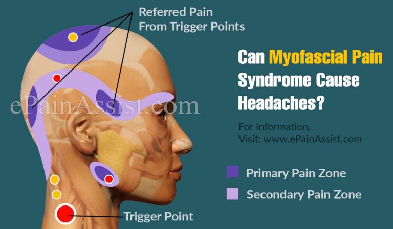 Can Myofascial Pain Syndrome Cause Headaches?