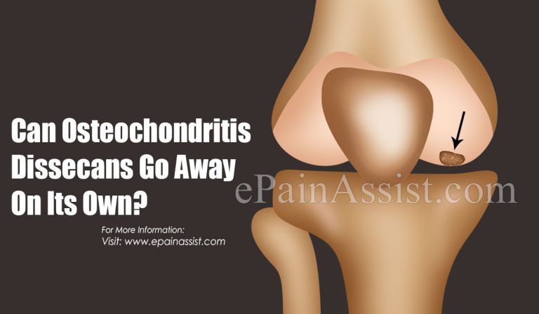 Can Osteochondritis Dissecans Go Away On Its Own & What Are Its Natural Remedies?