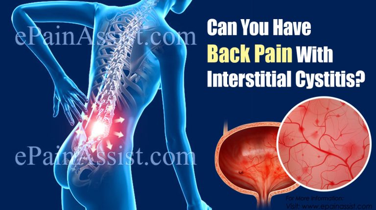 Can You Have Back Pain With Interstitial Cystitis & Does IC Cause Fatigue?