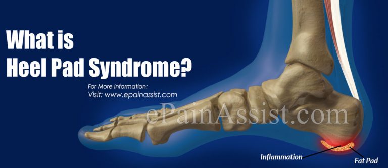 Heel Pad Syndrome: Causes, Symptoms, Treatment, Diagnoses
