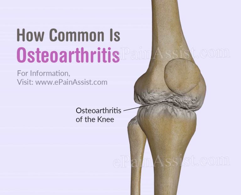 How Common Is Osteoarthritis Or Is It A Rare Disease?