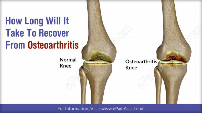 How Long Will It Take To Recover From Osteoarthritis & How Long Does The Symptoms Last?