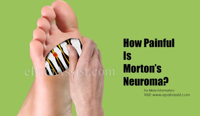 How Painful Is Morton’s Neuroma?