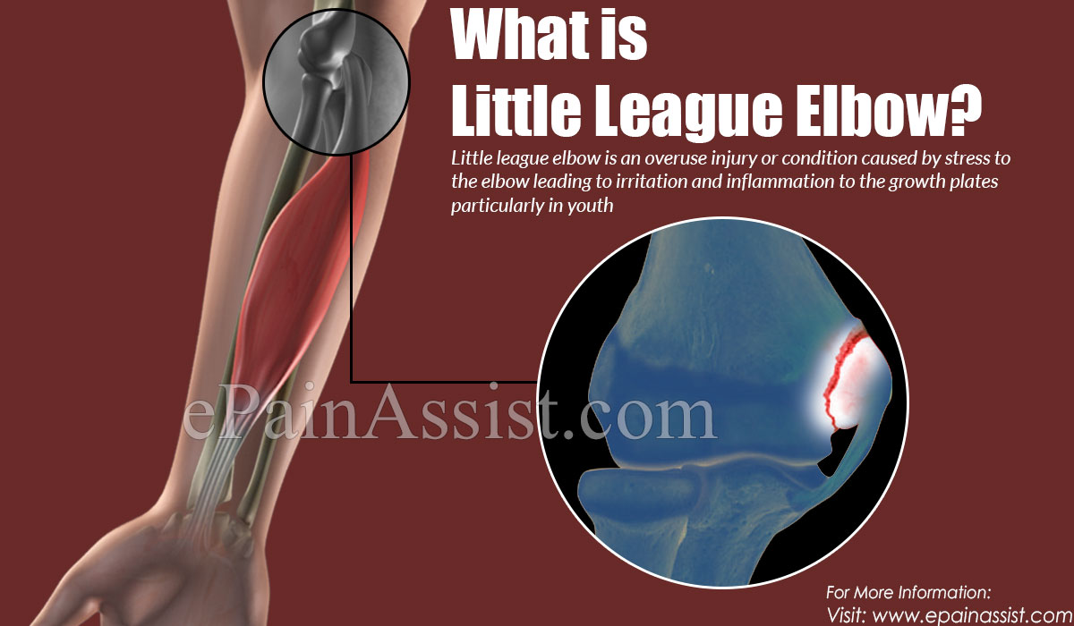 What is Little League Elbow?