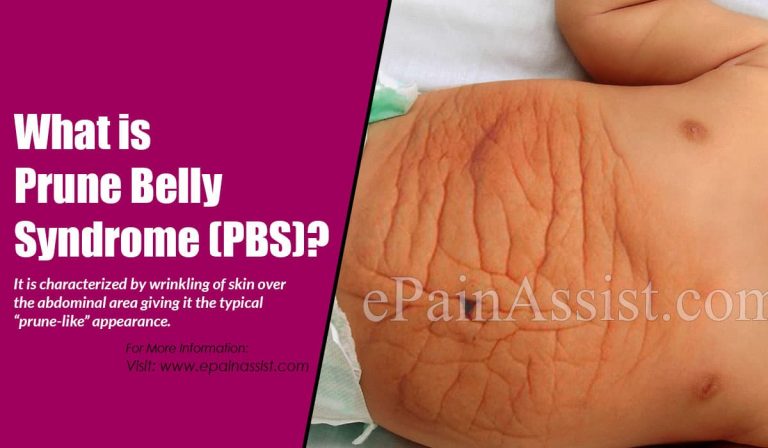Prune Belly Syndrome (PBS): Causes, Symptoms, Treatment, Diagnosis