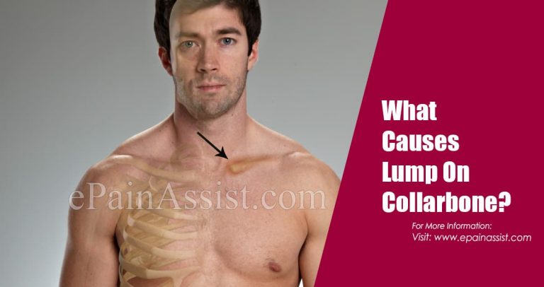 What Causes Lump On Collarbone & How is it Treated?