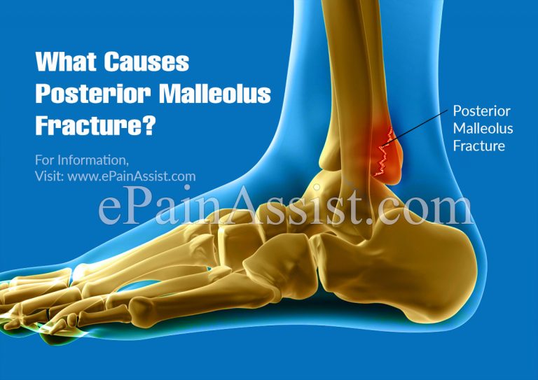 Posterior Malleolus Fracture: Causes, Symptoms, Diagnosis, Treatment, Recovery Time, Complications