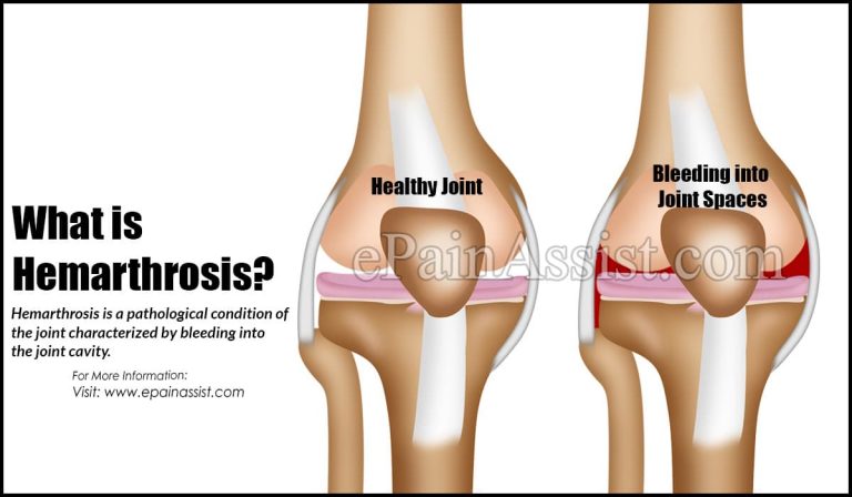 Hemarthrosis: Causes, Symptoms, Treatment
