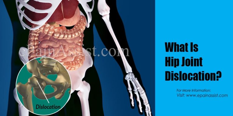 Frequently Asked Questions on Hip Joint Dislocation & Fracture