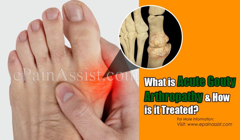 What is Acute Gouty Arthropathy & How is it Treated?| Causes, Symptoms, Risk Factors of Acute Gouty Arthropathy
