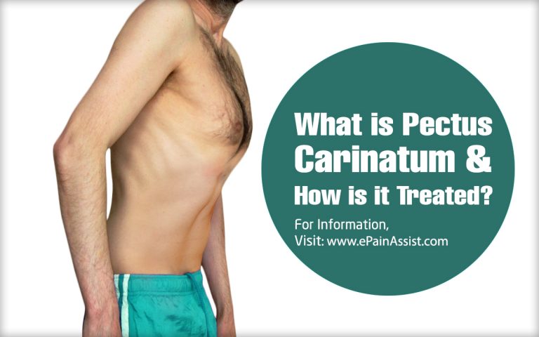 What is  Pectus Carinatum & How is it Treated? | Causes, Symptoms, Diagnosis of Pectus Carinatum