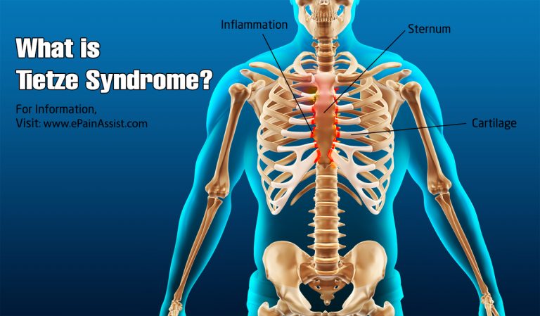 What is Tietze Syndrome | Symptoms | Causes | Risk Factors | Treatments