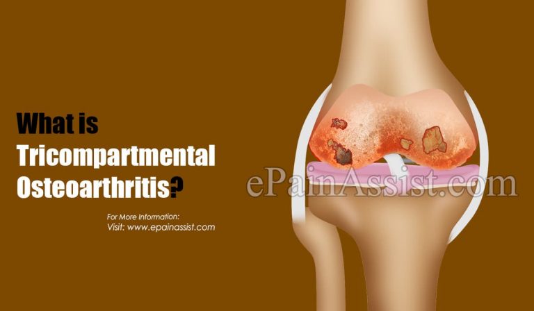 What is Tricompartmental Osteoarthritis: Causes, Symptoms, Treatment, Diagnosis