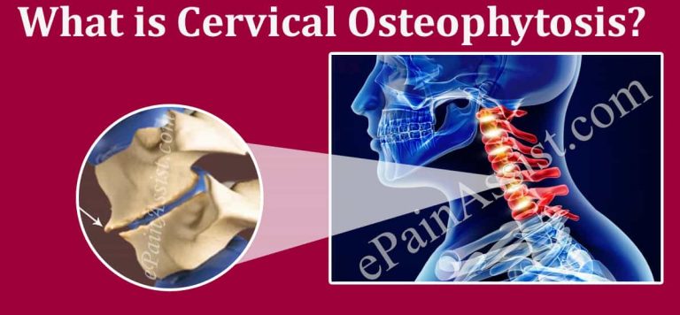 What is Cervical Osteophytosis: Causes, Symptoms, Treatment, Prognosis