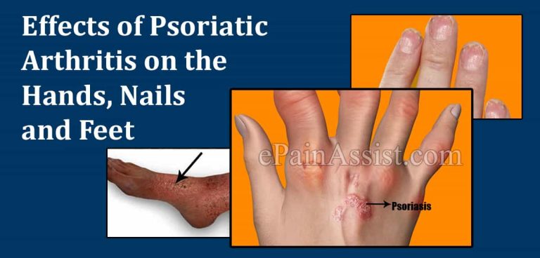 Effects of Psoriatic Arthritis on the Hands, Nails and Feet