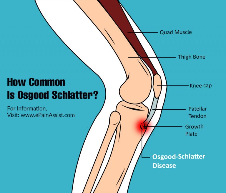 How Common Is Osgood Schlatter Or Is It A Rare Disease?
