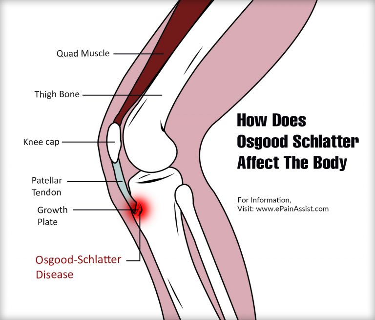 How Does Osgood Schlatter Affect The Body & What Triggers It?