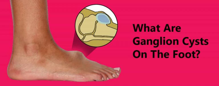 What are Ganglion Cysts On The Foot & How is it Treated? | Causes, Symptoms, Do’s & Don’ts of Ganglion Cysts On The Foot
