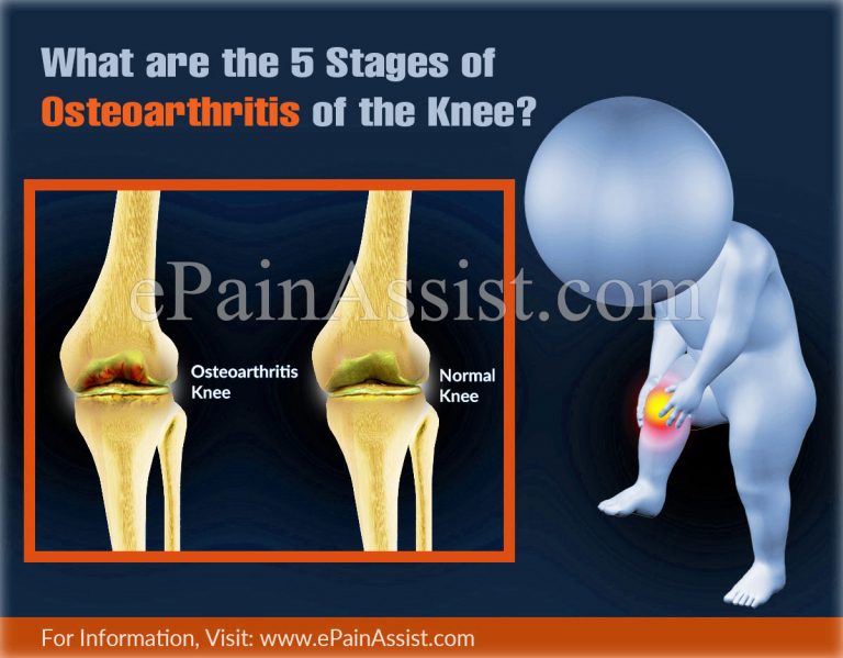 Understanding the Five Stages of Osteoarthritis of the Knee