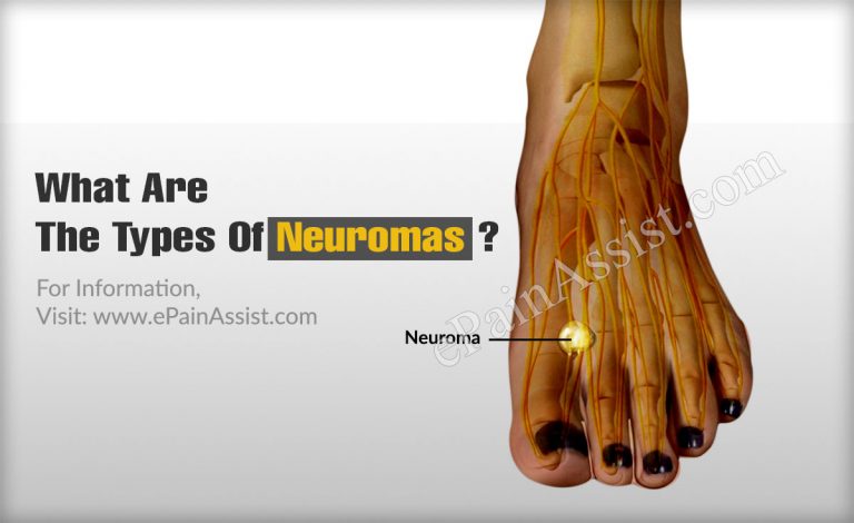 What Are The Types Of Neuromas?